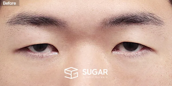슈가성형외과 첫) 눈썹하거상술 + 뒤밑트임 전후사진 - 수술 전