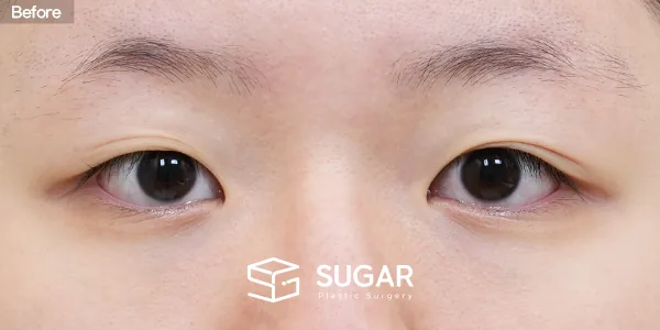 슈가성형외과 첫) 절개 + 눈매교정 + 앞트임 + 윗트임 전후사진 - 수술 전