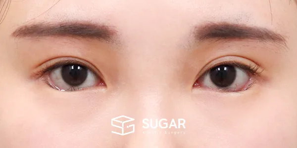 슈가성형외과 재) 재수술 + 2Point 웨이브 밑트임 전후사진 - 수술 후