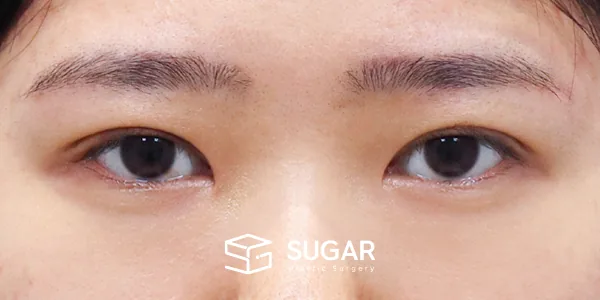 슈가성형외과 첫) 자연유착 + 눈매교정 + 윗트임 전후사진 - 수술 후