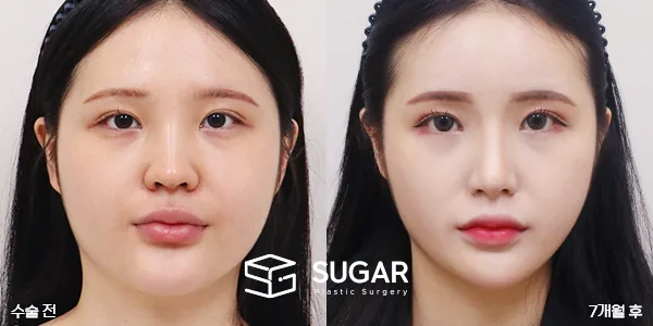 슈가성형외과 첫) 콧대+코끝+절골술+매부리+비중격+이중턱지방흡입 전후사진 - 45도 수술 전후 비교