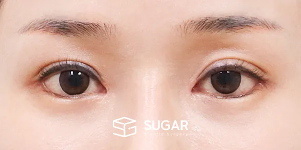 슈가성형외과 첫) 뒤밑트임 전후사진 - 수술 후
