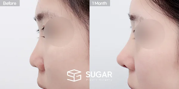 슈가성형외과 첫) 콧대+코끝+짧은코+복코+기증늑+귀연골 전후사진 - 측면 수술 전후 비교