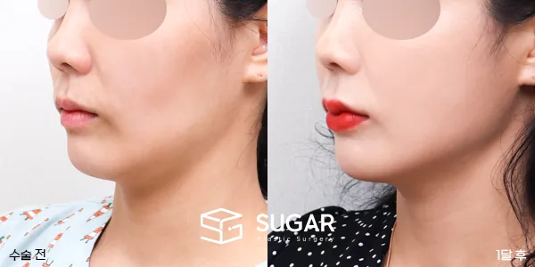 슈가성형외과 첫) 얼굴 지방이식 + 입술필러 전후사진 - 전후 비교 사진