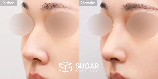 슈가성형외과 첫) 콧대 + 코끝 + 매부리코 전후사진 - 45도 수술 전후 비교