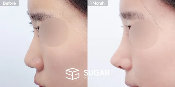 슈가성형외과 첫) 콧대+코끝+절골+콧대다듬기+복코+기증늑 전후사진 - 측면 수술 전후 비교