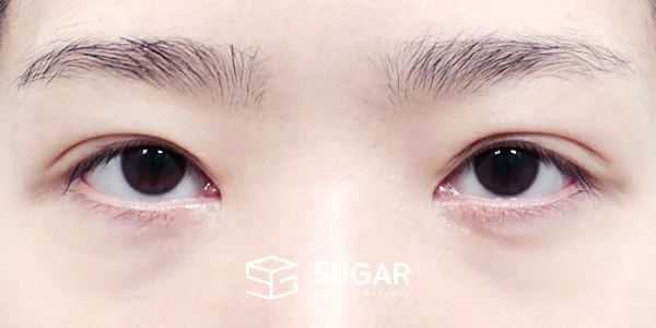 슈가성형외과 재) 재수술 + 절개 + 눈매교정 전후사진 - 수술 전