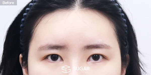 슈가성형외과 재) 자연유착 재수술 + 윗트임 + 뒤밑트임 + 이마거상 전후사진 - 수술 전