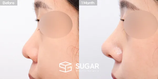 슈가성형외과 첫) 콧대 + 코끝 + 복코 전후사진 - 측면 수술 전후 비교