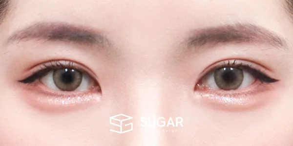 슈가성형외과 재) 재수술 + 자연유착 + 눈매교정 + 윗트임 전후사진 - 수술 후