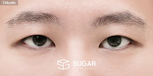 슈가성형외과 재) 재수술 + 절개 + 눈매교정 + 뒤트임 전후사진 - 수술 후