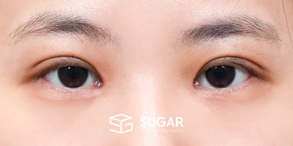 슈가성형외과 첫) 자연유착 + 눈매교정 + 앞트임 전후사진 - 수술 후