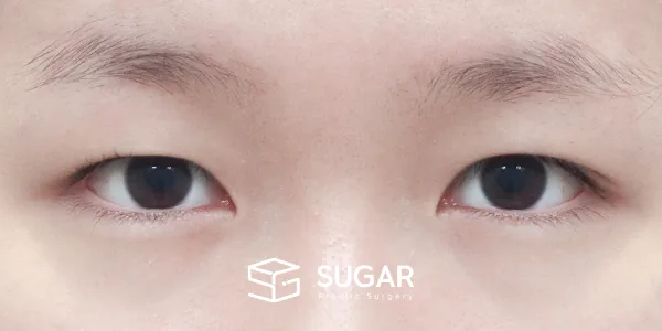 슈가성형외과 첫) 절개 + 뒤밑트임 전후사진 - 수술 전