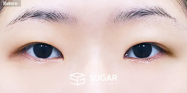 슈가성형외과 첫) 자연유착 + 눈매교정 + 윗트임 + 앞트임 + 뒤밑트임 전후사진 - 수술 전