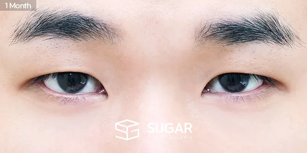 슈가성형외과 첫) 눈밑지방재배치 전후사진 - 수술 후