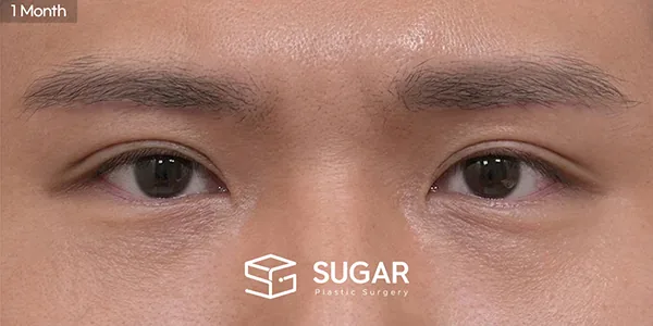 슈가성형외과 첫) 눈썹거상술 + 매몰쌍꺼풀 + 눈매교정 전후사진 - 수술 후