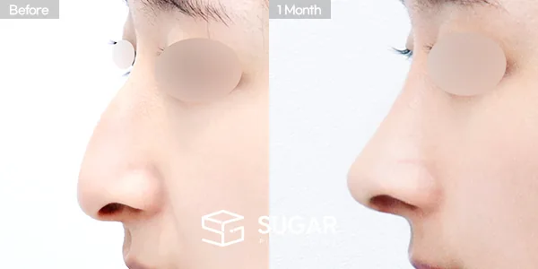 슈가성형외과 첫) 무보형물 + 콧대 + 코끝 + 매부리 + 비중격연장 + 귀연골 + 귀 뒤 근막 + 비순각교정 전후사진 - 측면 수술 전후 비교