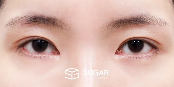 슈가성형외과 재) 재수술 + 자연유착 + 눈매교정 + 윗트임 전후사진 - 수술 전