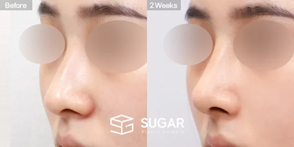 슈가성형외과 첫) 콧대 + 코끝 + 매부리코 + 휜코 전후사진 - 45도 수술 전후 비교