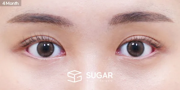 슈가성형외과 첫) 자연유착 + 눈매교정 + 앞트임 전후사진 - 수술 후