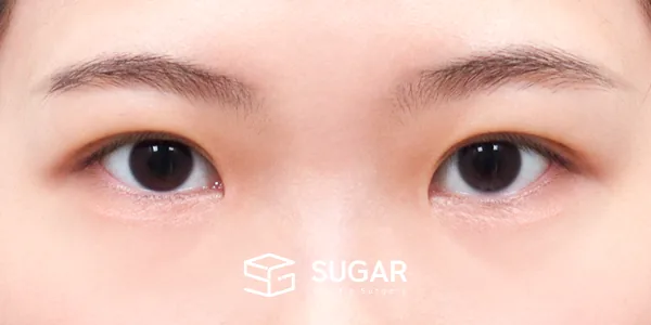 슈가성형외과 첫) 절개 + 눈매교정 + 앞트임 전후사진 - 수술 후