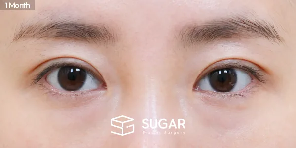 슈가성형외과 첫) 자연유착 + 눈매교정 + 윗트임 전후사진 - 수술 후