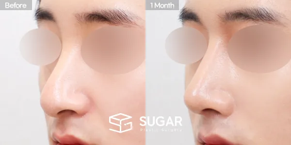 슈가성형외과 첫) 콧대 + 코끝 + 매부리코 + 휜코 + 절골 + 비중격 연장 전후사진 - 45도 수술 전후 비교