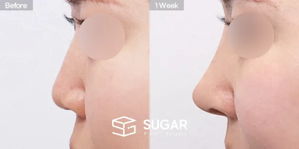 슈가성형외과 첫) 무보형물 + 자가늑 + 귀연골 + 복코 + 비주연장 + 비순각교정 + 절골 + 매부리 + 귀 뒤 근막 전후사진 - 측면 수술 전후 비교