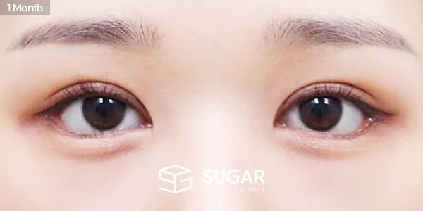 슈가성형외과 재) 재수술 + 절개 + 뒤밑트임 전후사진 - 수술 후