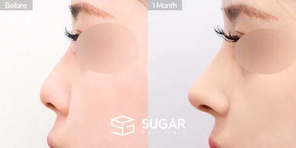 슈가성형외과 첫) 콧대 + 코긑 + 복코 + 절골 전후사진 - 측면 수술 전후 비교