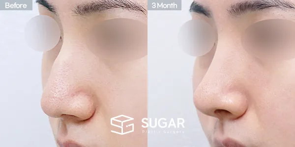 슈가성형외과 첫) 무보형물 + 매부리 + 비중격연장 + 귀 뒤 근막 + 귀연골 전후사진 - 45도 수술 전후 비교