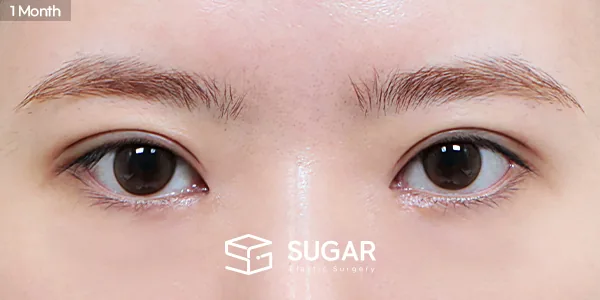 슈가성형외과 재) 재수술 + 절개 + 눈매교정 + 앞트임 전후사진 - 수술 후