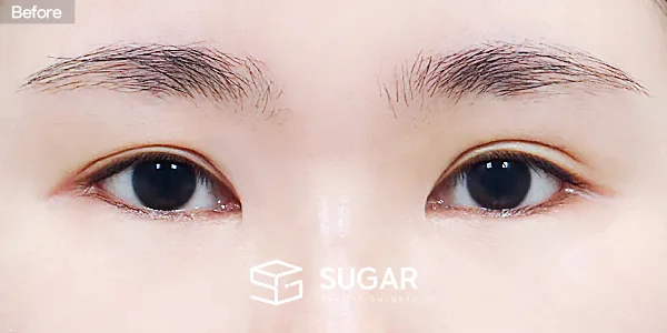슈가성형외과 재) 재수술 + 절개 + 눈매교정 + 밑트임 전후사진 - 수술 전
