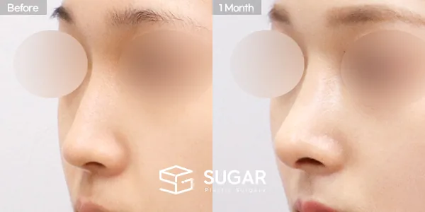 슈가성형외과 첫) 콧대 + 코끝 + 매부리코 + 비중격 전후사진 - 45도 수술 전후 비교