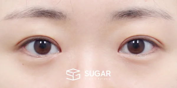 슈가성형외과 첫) 절개 + 윗트임 전후사진 - 수술 후