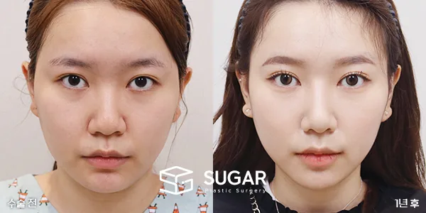 슈가성형외과 첫) 콧대+코끝+비중격+귀연골+복코교정+이중턱지방흡입 전후사진 - 45도 수술 전후 비교
