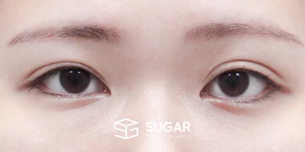 슈가성형외과 첫) 자연유착 + 눈매교정 전후사진 - 수술 전
