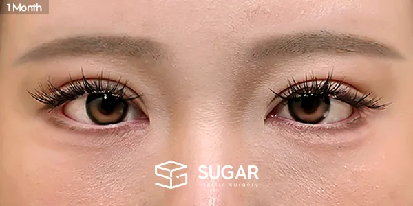 슈가성형외과 첫) 비절개눈매교정 + 윗트임 + 웨이브뒤밑트임 전후사진 - 수술 후