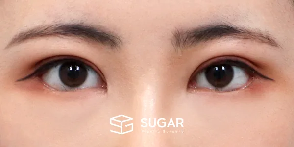 슈가성형외과 첫) 절개 + 눈 밑 지방재배치 + 윗트임 + 뒤밑트임 전후사진 - 수술 후