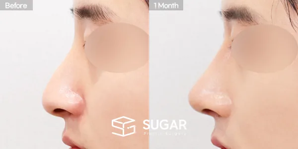슈가성형외과 첫) 콧대 + 코끝 + 매부리코 + 휜코 + 절골 + 비중격 연장 전후사진 - 측면 수술 전후 비교