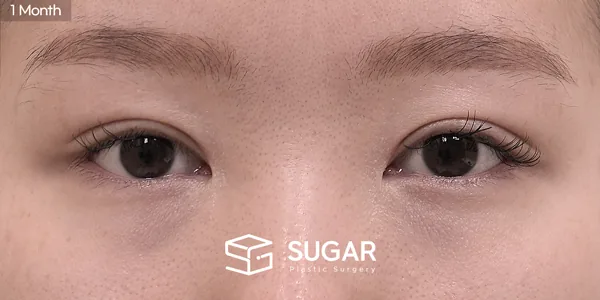 슈가성형외과 첫) 비절개눈매교정 + 윗트임 전후사진 - 수술 후