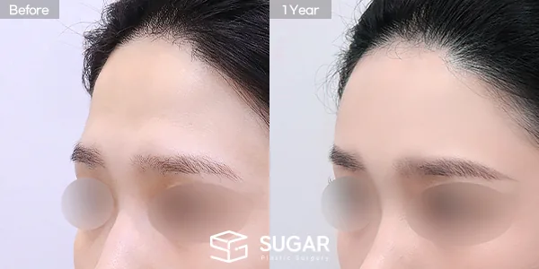 슈가성형외과 첫) 이마필러 전후사진 - 전후 비교 사진