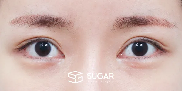 슈가성형외과 재) 재수술 + 절개(두 줄 따기) + 뒤밑트임 전후사진 - 수술 전