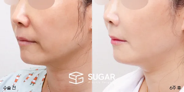 슈가성형외과 첫) 실리프팅 + 팔자주름 필러 전후사진 - 전후 비교 사진