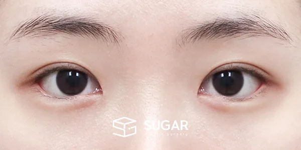 슈가성형외과 첫) 자연유착 + 앞트임 + 뒤밑트임 전후사진 - 수술 후
