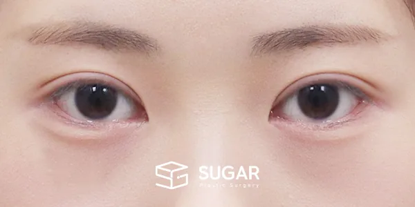 슈가성형외과 첫) 자연유착 + 눈매교정 전후사진 - 수술 후
