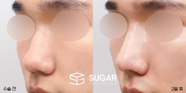 슈가성형외과 재) 코재수술 + 매부리 + 복코 + 기증늑 전후사진 - 45도 수술 전후 비교