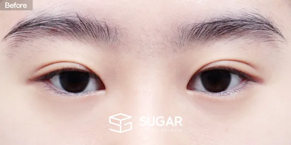 슈가성형외과 첫) 윗트임 + 뒤밑트임 전후사진 - 수술 전
