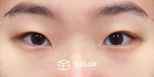 슈가성형외과 첫) 자연유착 + 눈매교정 + 앞트임 + 뒤밑트임 전후사진 - 수술 전