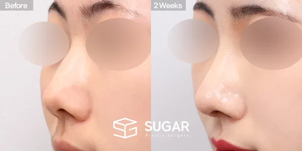 슈가성형외과 첫) 콧대 + 코끝 + 매부리코 전후사진 - 45도 수술 전후 비교